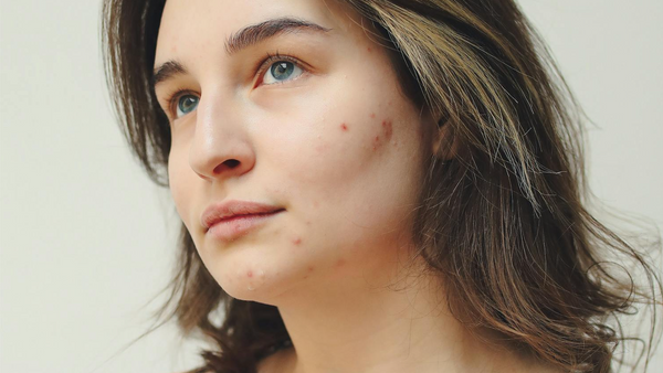 Quick Acne Guide