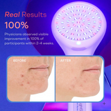 LED Blue Light for Acne